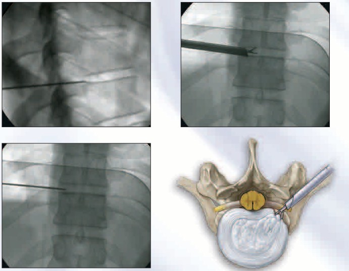 R.Wolf 20 deg Panoview Plus Spine Endoscope 8792.411