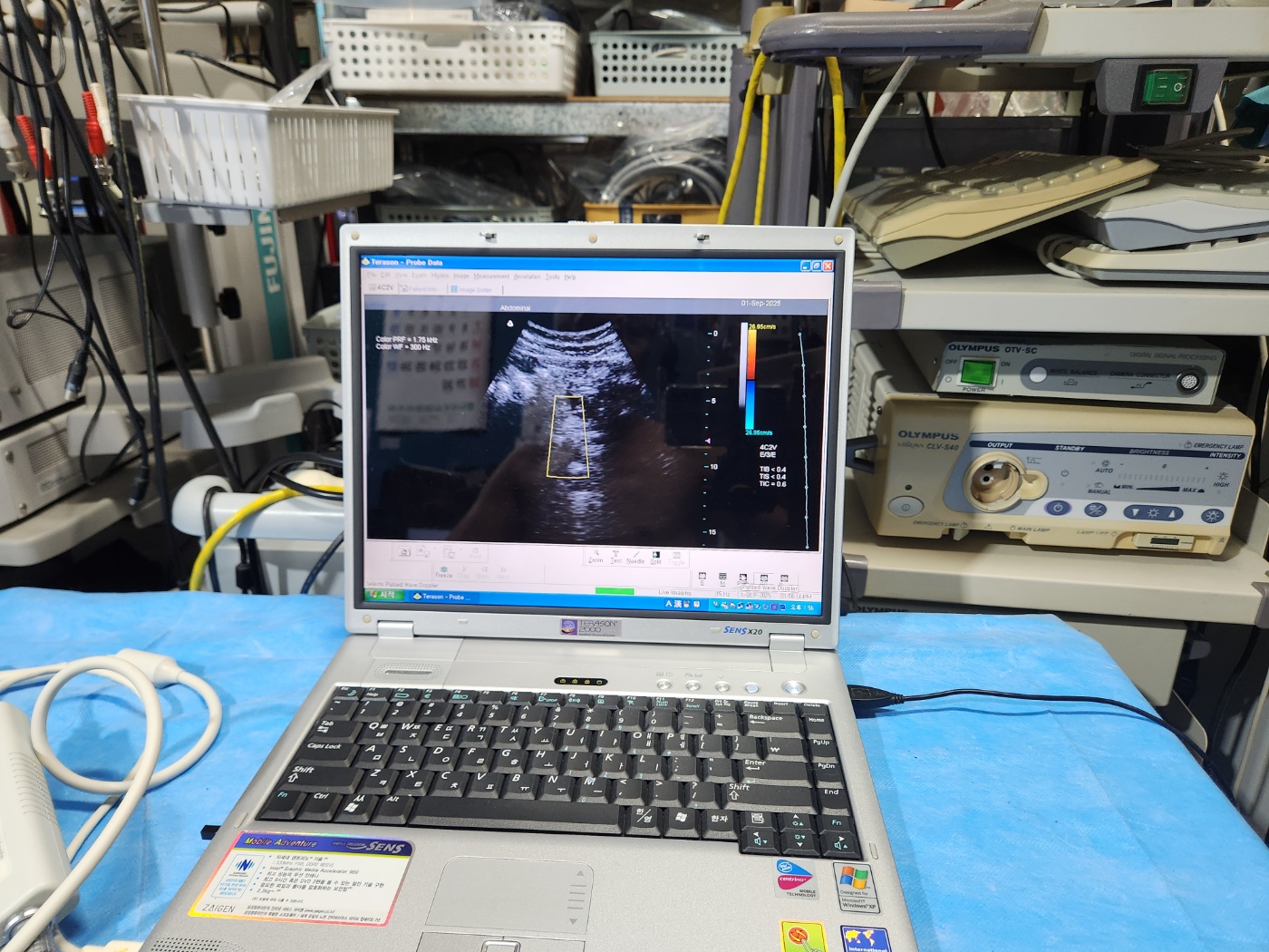 TERASON 2000 Handheld Ultrasound System