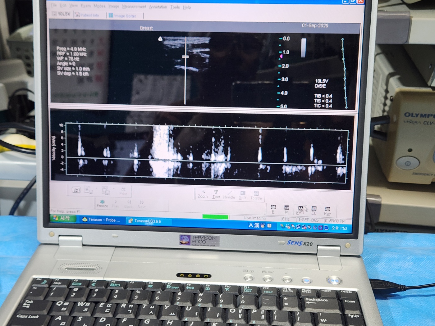 TERASON 2000 Handheld Ultrasound System